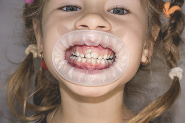 Adult permanent teeth coming in front of the child's baby teeth: shark teeth.