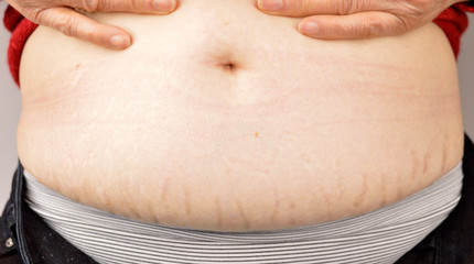 Woman showing stretch marks