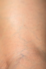 Spider veins on human leg