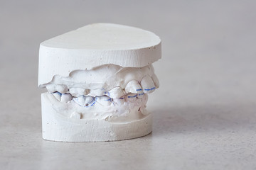 Dental plaster model, distal occlusion