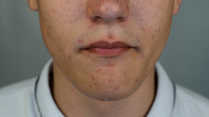 Teenager with pimples and acne on the face. Close up