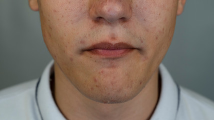 Fototapeta premium Teenager with pimples and acne on the face. Close up
