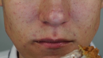 A young man with pimples and acne on his face is eating the big crispy chicken feet. Concept junk food, genetically modified meals and unhealthy food