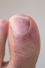 Big Toe with Ingrown Toenail, Scaly, Dry Skin and Cracking
