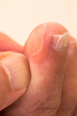 Toe with Big Blister on the side Dry Skin and Cracking