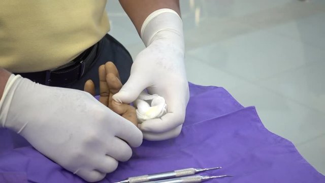 Trigger finger operation. Medical treatment , Digital flexer tenosynvitis, Stenosing tenosynvits