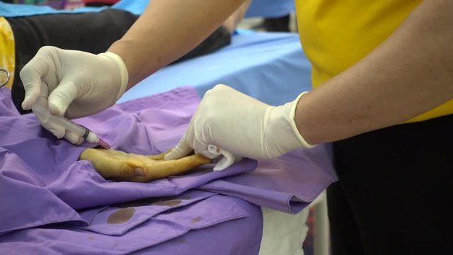 Trigger finger operation. Medical treatment , Digital flexer tenosynvitis, Stenosing tenosynvits