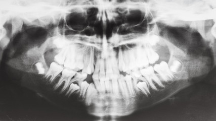 human jaws on X-ray image