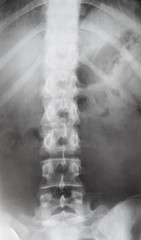 view of human spine in torso on X-ray image