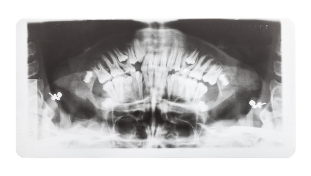 film with X-ray image of human jaws isolated