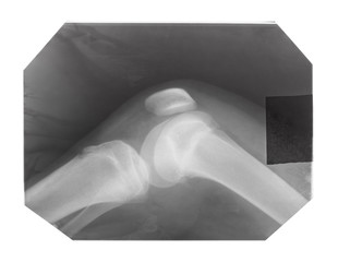 film with X-ray image of knee-joint with kneecap