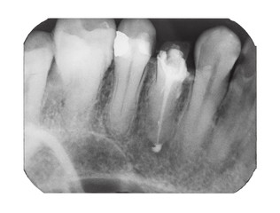 X-ray image of human teeth with dental pin