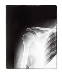 X-ray image of human shoulder joint