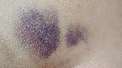 Close up of contusion or bruise or black and blue on human skin.