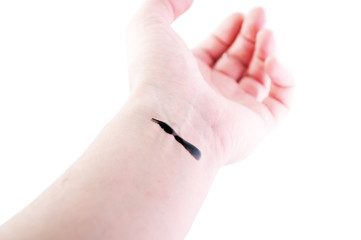 Arm is wound from a knife. A vein cut on the arm is bleeding.