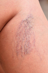 Varicose veins on female legs in the area of the knee and calves. Sipder veins thigh, close-up