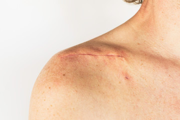 Fototapeta premium scar on the of a male body after surgery on a broken collarbone, acromion and shoulder