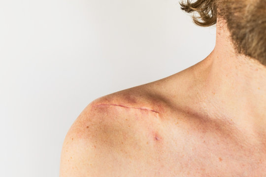 scar on the of a male body after surgery on a broken collarbone, acromion and shoulder