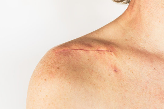 scar on the of a male body after surgery on a broken collarbone, acromion and shoulder