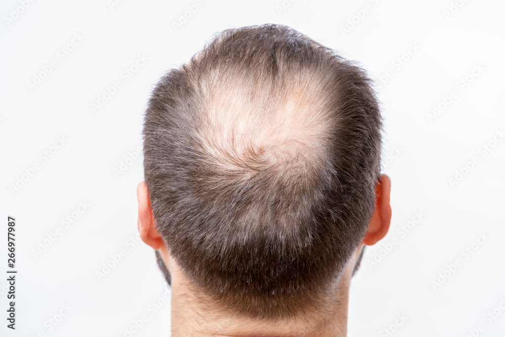 Poster bald man has a problem of head baldness and hair loss