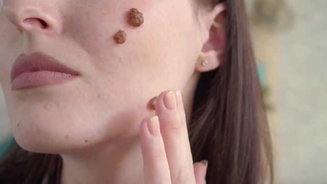 Close up of moles on the face of a young woman