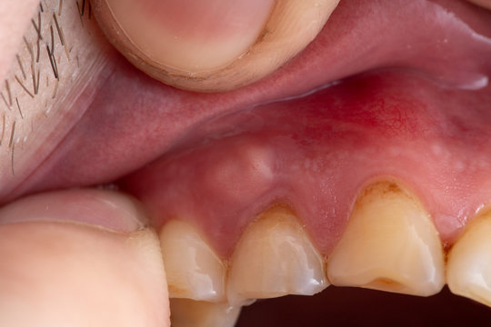 inflammation of the gums abscess closeup, teeth in poor condition with caries