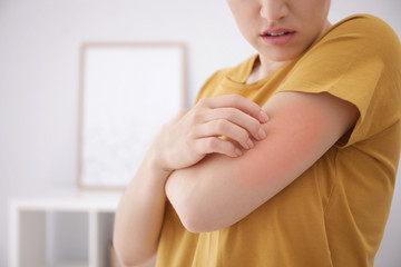 Woman scratching arm indoors, closeup with space for text. Allergy symptoms