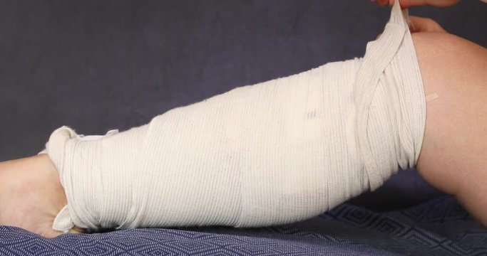 Female patient leg after the medical varicose veins surgery