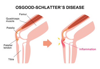 Osgood-schlatter disease (knee joint disease) illustration