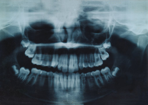 Panoramic dental and mandible x-ray image with intact teeth and four intact upcoming wisdom teeth.