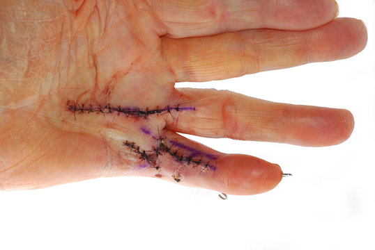 Man's Hand with Stitches and Steel Pins from Dupuytren Contracture Surgery