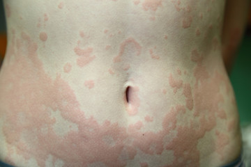 allergic dermatitis - obrazy, fototapety, plakaty