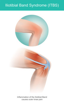 The Iliotibial Band is a longitudinal fibrous reinforcement of the fascia lata in a knee muscle. Part of anatomy human body. Illustration.