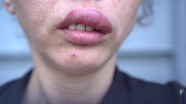 Allergic reaction to insect sting. A woman who are stung by a bee. Edema, swelling lips