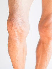 Knees that have problems with the deterioration of the bones of