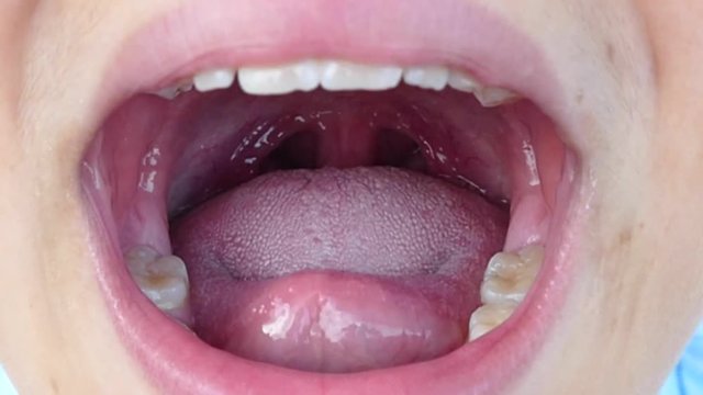 a child's tonsils mouth inside and tonsillitis...