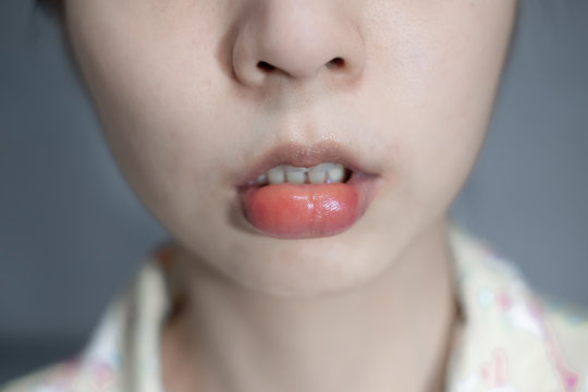 Closeup swollen lip of asian woman caused by insect bite, insect sting allergy, lip swollen.