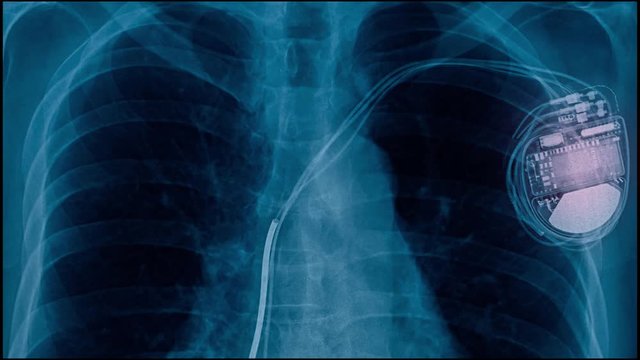 clavicle fracture and fixed and pain shoulder