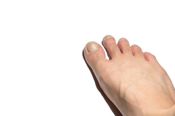 Nail disease on white background with clipping path and blank space for text or design