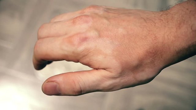 hands closeup on skin vitiligo skin disease
