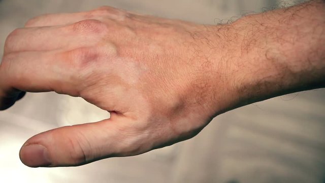 hands closeup on skin vitiligo skin disease