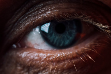the eye is severely inflamed. macro reddening. have toning. focus on the eyelash
