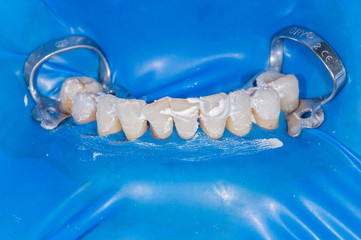 Real patient dental surgery