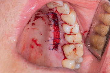 Obraz premium Real patient dental surgery