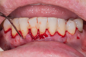 Real patient dental surgery