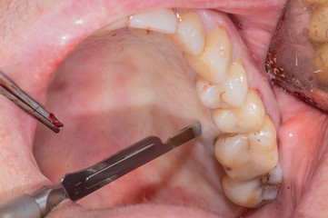 Real patient dental surgery