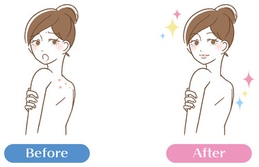 背中　ニキビ跡　毛穴汚れ　女性　ビフォーアフター