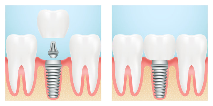 Human teeth and dental implant cut scheme. Stock vector illustration, eps 10.