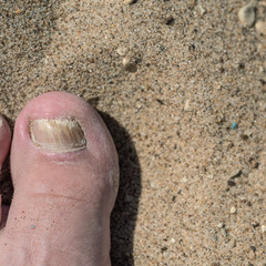 Toes with fungus - the concept of skin diseases in the summer on the beach