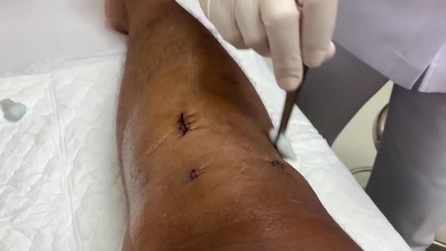 Clean the wound With alcohol after Knee Surgery The anterior cruciate ligament (ACL) is one of a pair (the other being the posterior cruciate ligament) in the human knee.